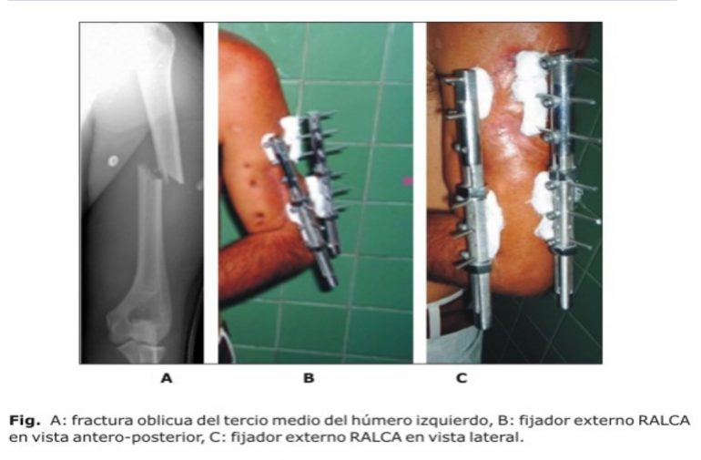 Tratamiento De Las Fracturas Diafisarias Del Húmero Con Fijación Externa ósea Monolateral 0234